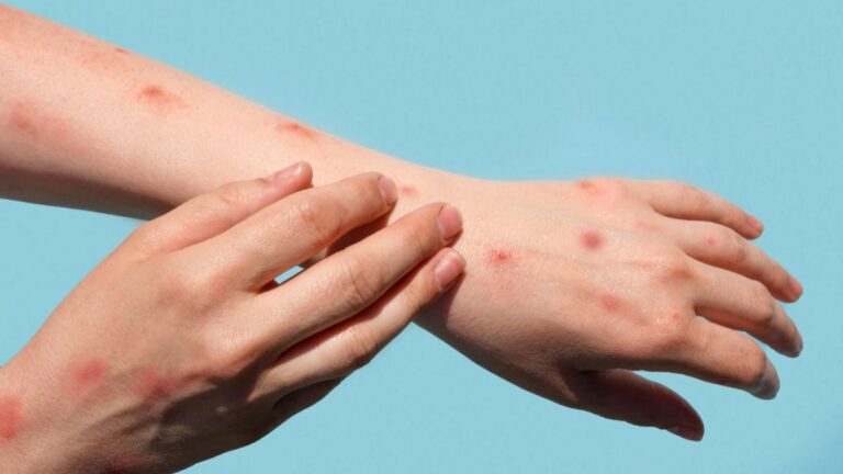 Hay 5 casos en México de la viruela del mono; cuatro en CDMX y uno en Jalisco