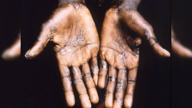 “Alimenta estigma y discriminación”: Salud pide no relacionar viruela del mono con comunidad LGBT+