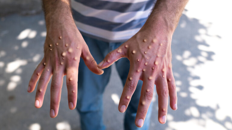 Suman 4 estados más con casos de viruela del mono en México