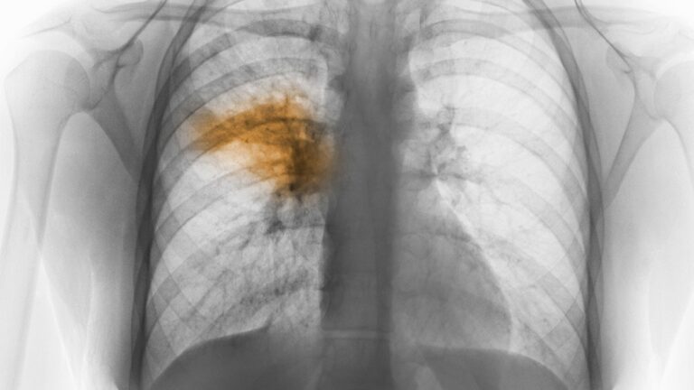 ¿Qué es la misteriosa neumonía bilateral surgida en Argentina y cuáles son sus síntomas?
